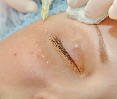 Мезотерапия области вокруг глаз